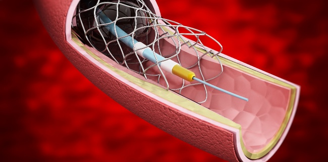 Sterile medical implant Sterile medical implant